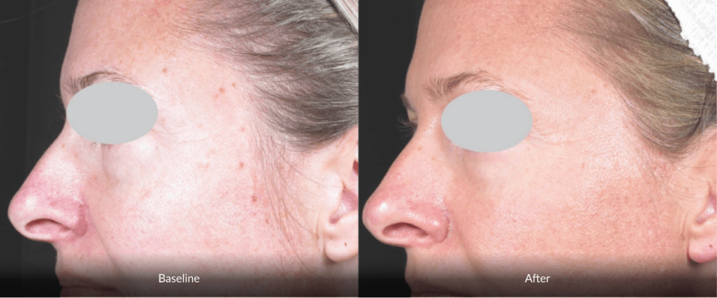 Before And After Photofabulous Treatment