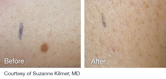 Laser Hair Removal Before And After