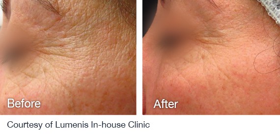 Laser Hair Removal Before And After