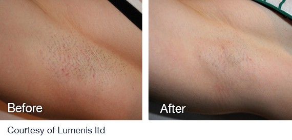 Laser Hair Removal before and after