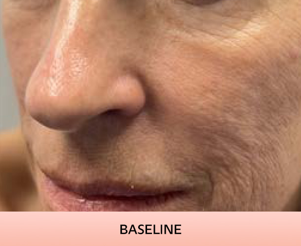 Cheekbones before triLift treatment