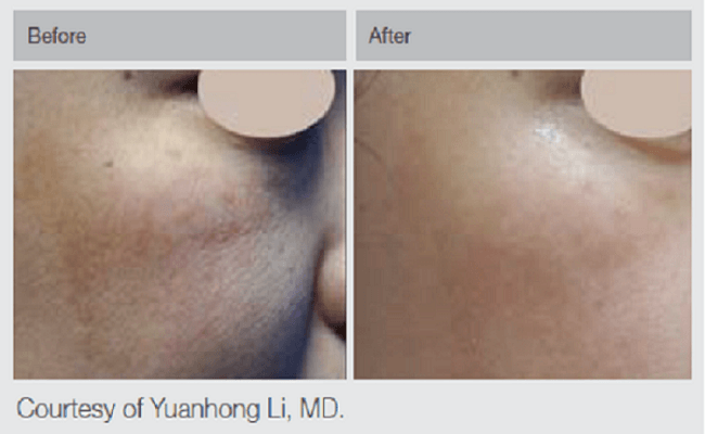Q-Switched Nd:YAG Before And After