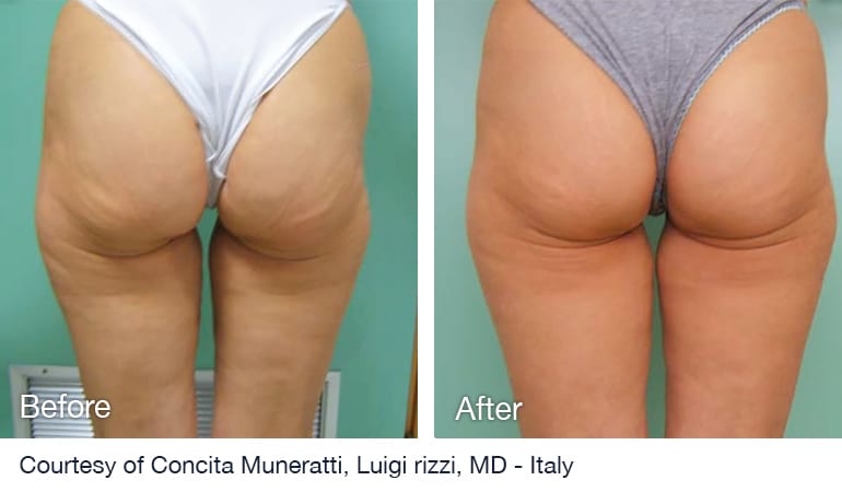 Before And After NuEra tight Skin Smoothing Treatment