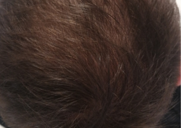 FoLix hair loss treatment before and after photos