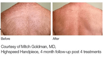 before-after-lightsheer_New_2