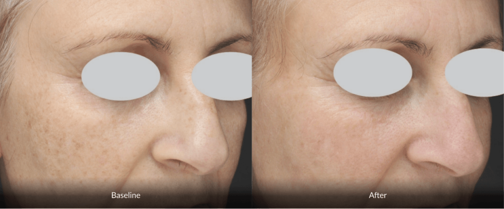 Before And After Photofabulous Treatment