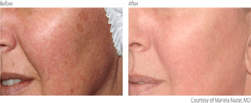 before and after Vascular Lesions treatment