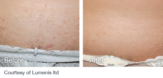 Laser Hair Removal before and after