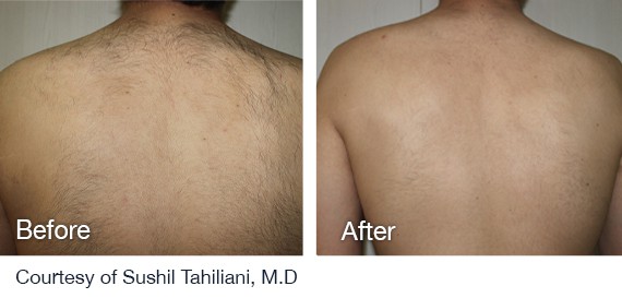 Laser Hair Removal Before And After