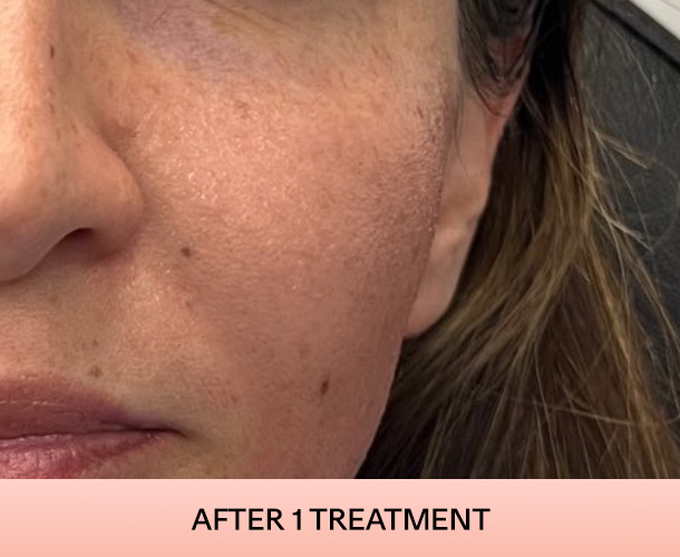 Cheekbones after triLift treatment