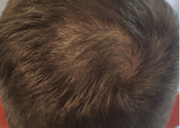 FoLix hair loss treatment before and after photos