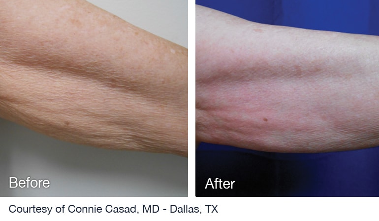 Before And After NuEra tight Skin Smoothing Treatment