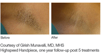 before-after-lightsheer_New_1