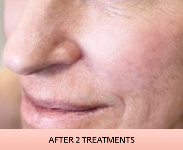 Cheekbones after triLift treatment