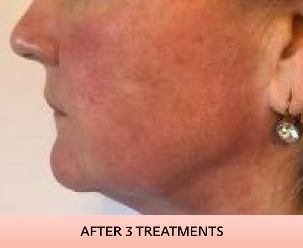 Jawline after triLift treatment