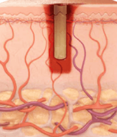 SuperPulse pulse profile illustration