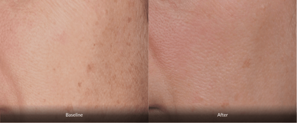 Before And After Photofabulous Treatment