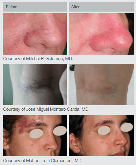 Nd:YAG Laser Results