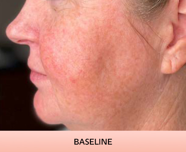 Cheekbones before triLift treatment