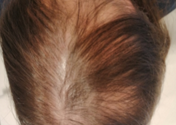 FoLix hair loss treatment before and after photos