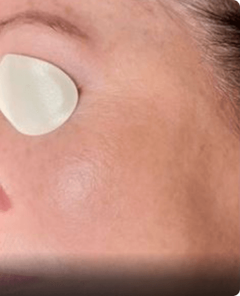 smoothglo treatment before and after