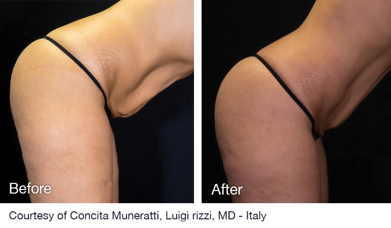 Before And After NuEra Tight Skin Smoothing Treatment