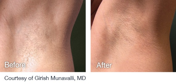 Laser Hair Removal Before And After