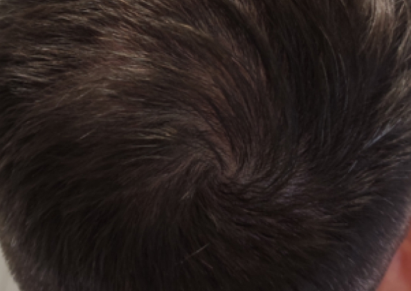 FoLix hair loss treatment before and after photos