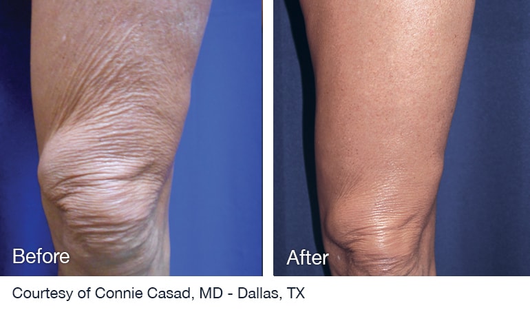 Before And After NuEra tight Skin Smoothing Treatment