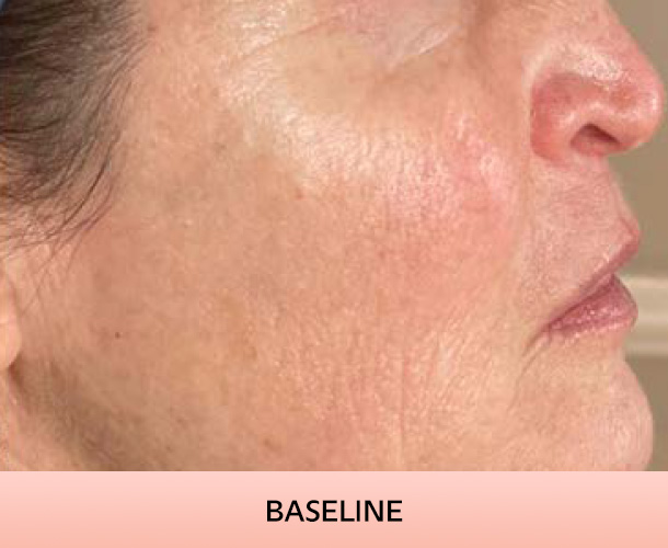 Cheekbones before triLift treatment