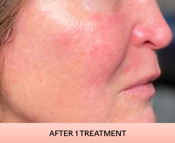 Cheekbones after triLift treatment